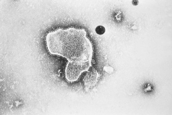This 1981 photo provided by the Centers for Disease Control and Prevention shows an electron micrograph of respiratory syncytial virus, also known as RSV.