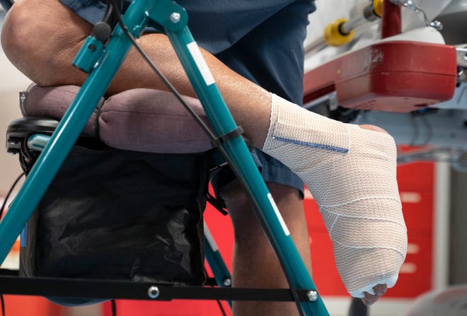 Bert Krebs after a shark bit his foot while he surfing in the southern Martin County.