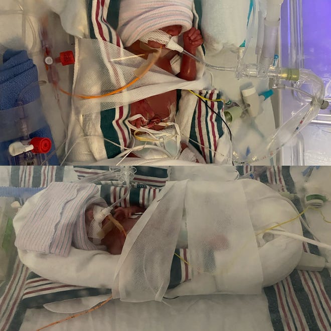 Twins Melody and Ezra del Rosal were born prematurely at 25 weeks, weighing less than 2 pounds, with multiple medical issues. For their first few months, their survival was not certain.