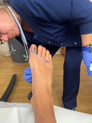 Matthew Picarelli, 36, of Stuart, said he was body surfing at Pepper Park Beach in St. Lucie County  March 12, 2023, when something grabbed his foot. He saw the fin and tail of the shark that he said latched on to him. He shows the damage to his foot, after treatment.